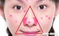 每次“挤痘痘”滋出的白色物质，是什么东西呢如何祛痘