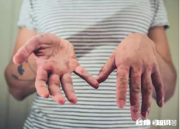 得过手足口病的儿童，以后还会得吗