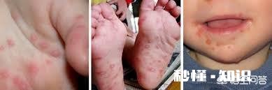 得过手足口病的儿童，以后还会得吗