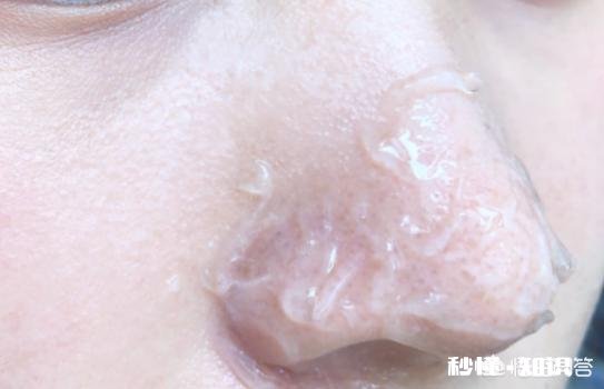 鼻子黑头反复，是什么原因导致的，又要如何去除黑头呢