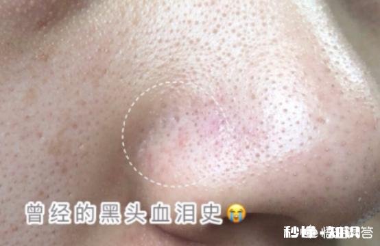 鼻子黑头反复，是什么原因导致的，又要如何去除黑头呢