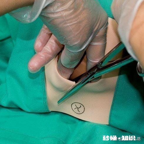 顺产的孕妈侧切是必须的吗十个产妇九个切，什么情况下会使用侧切呢