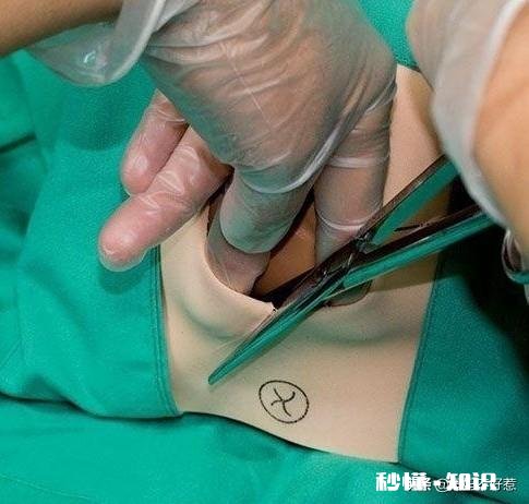 顺产的孕妈侧切是必须的吗十个产妇九个切，什么情况下会使用侧切呢