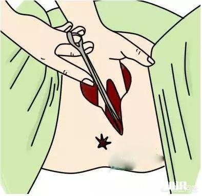 顺产的孕妈侧切是必须的吗十个产妇九个切，什么情况下会使用侧切呢