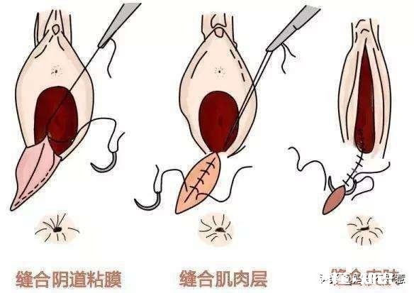 顺产的孕妈侧切是必须的吗十个产妇九个切，什么情况下会使用侧切呢