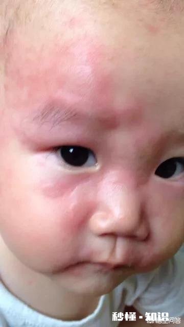 宝宝脸上长了一层小疙瘩，是湿疹吗