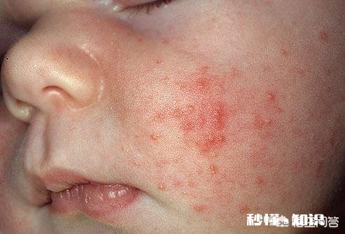 宝宝脸上长了一层小疙瘩，是湿疹吗