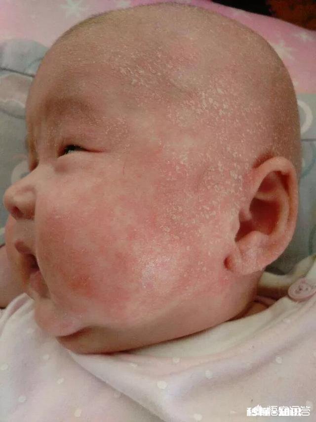 宝宝脸上长了一层小疙瘩，是湿疹吗