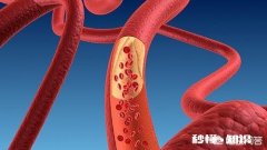 该如何预防动脉堵塞
