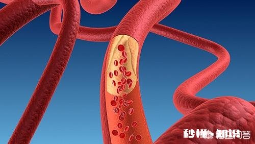 该如何预防动脉堵塞