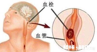 该如何预防动脉堵塞