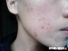 有什么适合学生的祛痘印护肤品