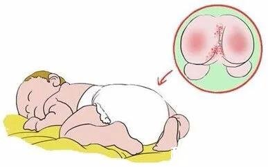 宝宝红屁屁需要怎么护理呢