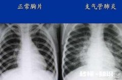 为什么有些宝宝很小就得了肺炎