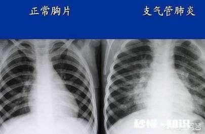 为什么有些宝宝很小就得了肺炎