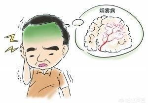 为什么会得烟雾病