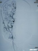 为什么会得烟雾病