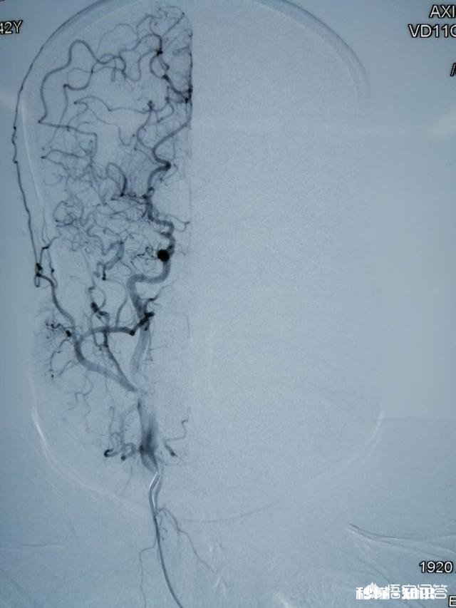 为什么会得烟雾病