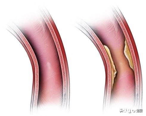 如何做颈动脉狭窄查检需要注意些什么