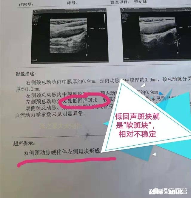 如何做颈动脉狭窄查检需要注意些什么