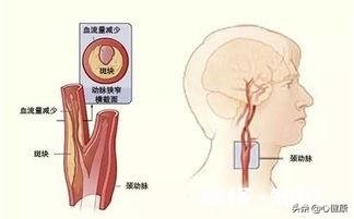 如何做颈动脉狭窄查检需要注意些什么