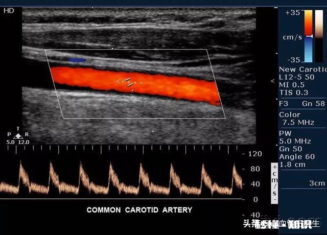 如何做颈动脉狭窄查检需要注意些什么