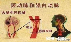 如何做颈动脉狭窄查检需要注意些什么