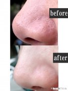 除了脸以外的黑头大到直接挤出来是什么感受