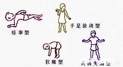 脑瘫的类型有哪些