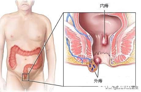 如果知道自己得了痔疮，不好意思告诉家里人怎么办