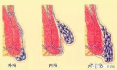如果知道自己得了痔疮，不好意思告诉家里人怎么办