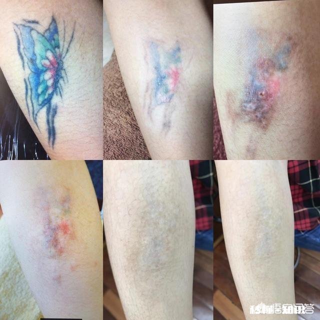 文身对身体有没有影响如果以后想洗掉会不会很麻烦