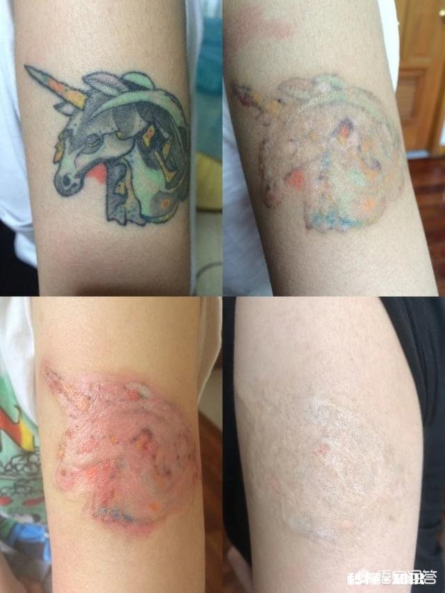 文身对身体有没有影响如果以后想洗掉会不会很麻烦