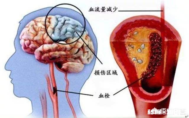 是不是所有的颈动脉斑块都需要终生服药呢如何区分斑块稳定性呢