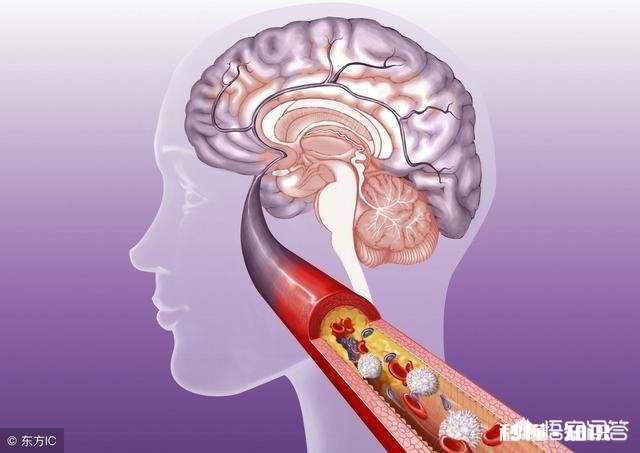 是不是所有的颈动脉斑块都需要终生服药呢如何区分斑块稳定性呢