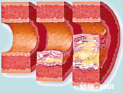 是不是所有的颈动脉斑块都需要终生服药呢如何区分斑块稳定性呢