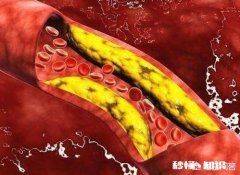 是不是所有的颈动脉斑块都需要终生服药呢如何区分斑块稳定性呢
