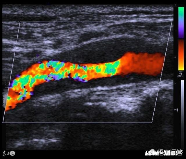 是不是所有的颈动脉斑块都需要终生服药呢如何区分斑块稳定性呢