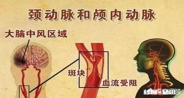 是不是所有的颈动脉斑块都需要终生服药呢如何区分斑块稳定性呢