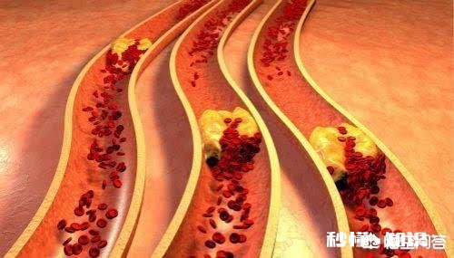 是不是所有的颈动脉斑块都需要终生服药呢如何区分斑块稳定性呢