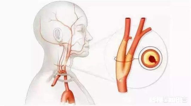 是不是所有的颈动脉斑块都需要终生服药呢如何区分斑块稳定性呢