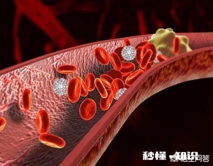 是不是所有的颈动脉斑块都需要终生服药呢如何区分斑块稳定性呢