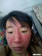 皮肤有红血丝而且容易长痘的人，用什么护肤品比较好