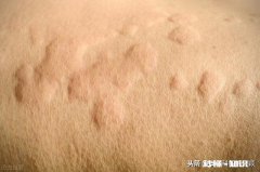 荨麻疹可怕吗