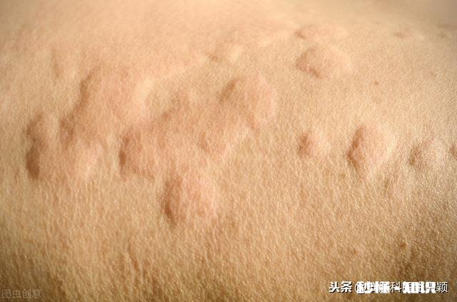 荨麻疹可怕吗