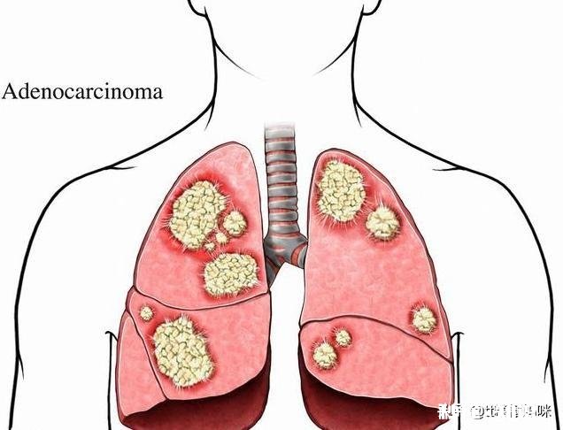 大人有支气管肺炎带宝宝会传染吗