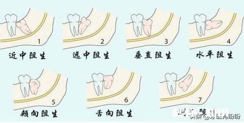 智齿一定要拔掉吗牙龈上火痛怎么办