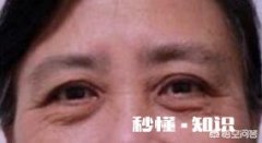 眼袋有皱纹该怎么消除