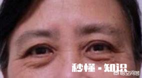 眼袋有皱纹该怎么消除