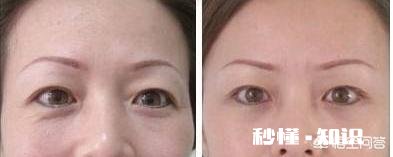 眼袋有皱纹该怎么消除